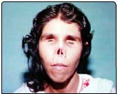 Zahida's husband brutally attacked her alleging she had been unfaithful & brought shame to the family. He cut off her ears, tongue, nose, eyes, & left her for dead.