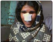 Zahida wore a cloth nose bandage to cover her disfigured face after the attempted honor killing